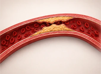 Coronary Artery Disease