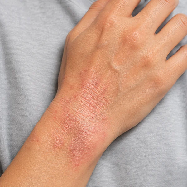 Hemophilia
