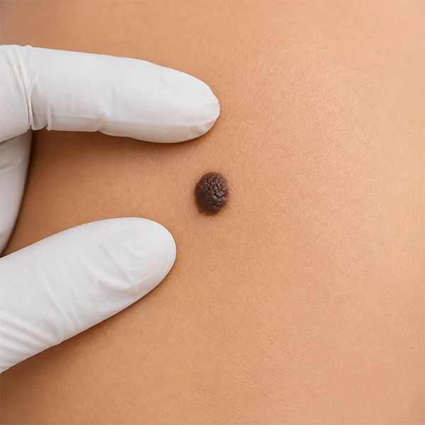 Lymphoma