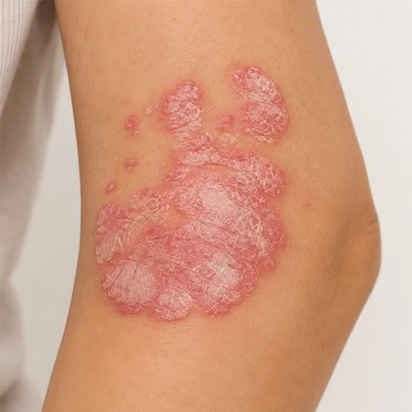 Thrombocytopenia (ITP)