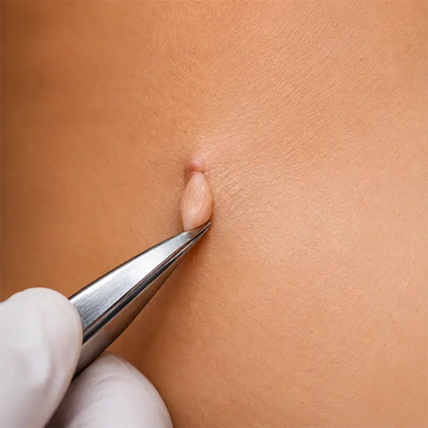 Skin tag removal treatment